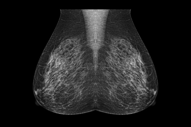 Un radiólogo explica qué esperar en su primera mamografía